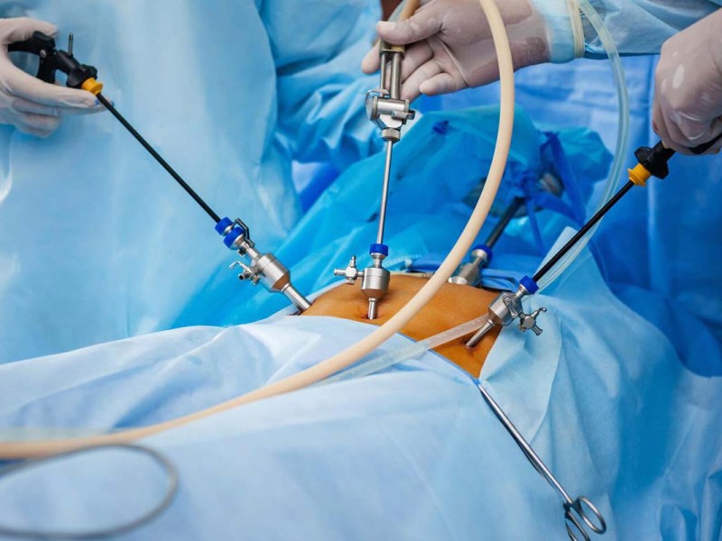 Reprocesado de material de laparoscopia y el vaho de sus&nbsp;lentes